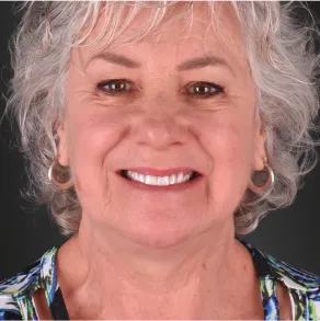 All-on-4 dental implant service in Mexico, offering an effective and durable solution for smile restoration.