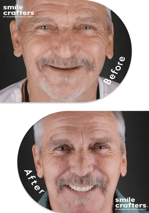 Transformation image showing before and after effects of All-on-4 implants in Mexico.