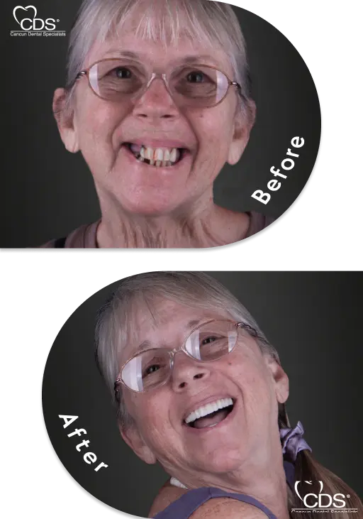 Patient’s dramatic smile makeover with All-on-4 implants in Mexico, before and after photos.