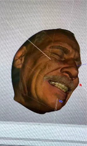 Smile design service offered at our clinic in Mexico, providing personalized smile transformations